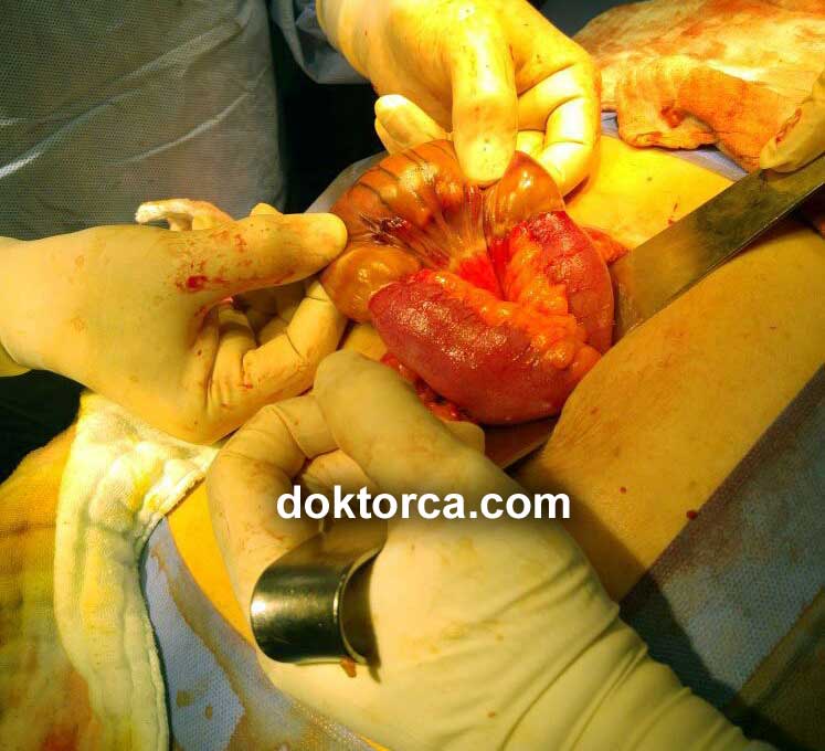 Barsak Çürümesi ameliyatı