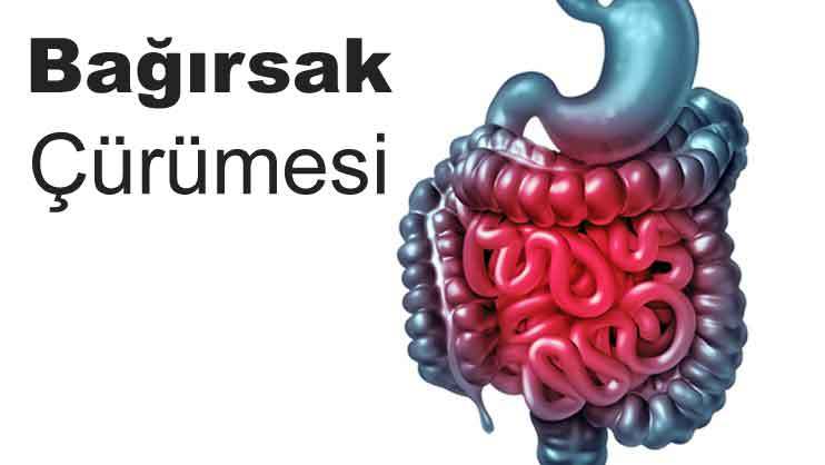 Bağırsak Çürümesi nedir?