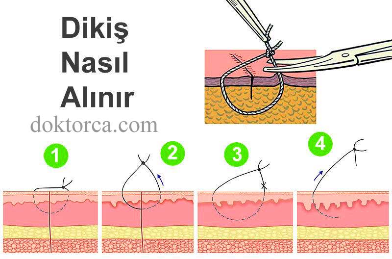 Ameliyat Dikişleri Nasıl Alınır