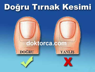 Doğru Tırnak Kesimi — Uzamış tırnaklar mümkün olduğunca düz olarak kesilmelidir.