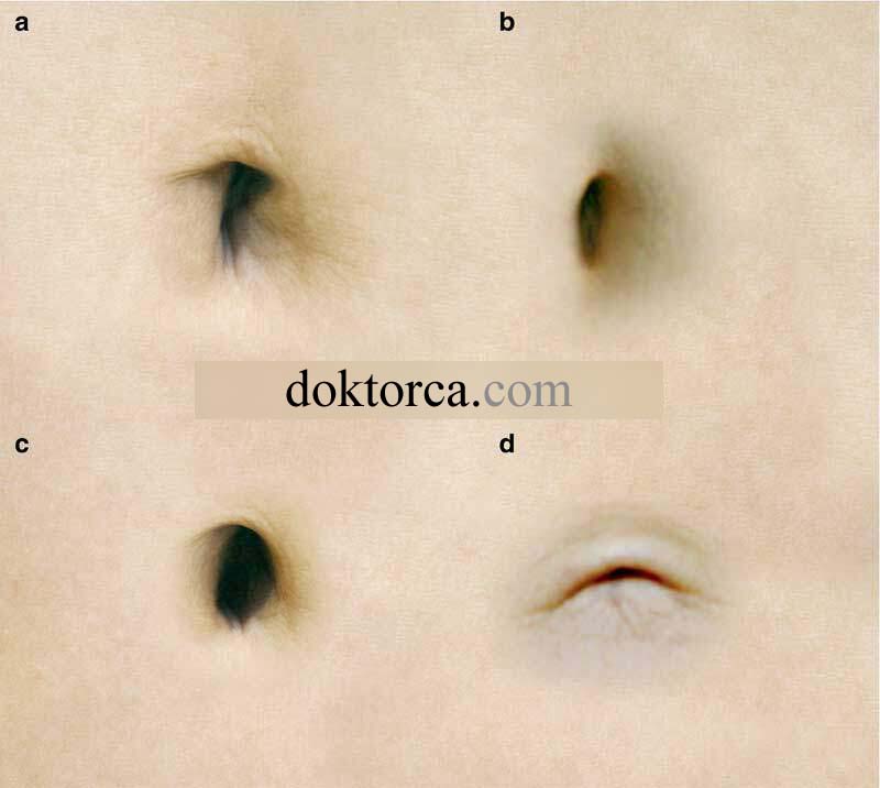 Göbek Türleri nelerdir?