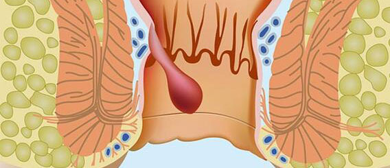 hemoroid nedir?