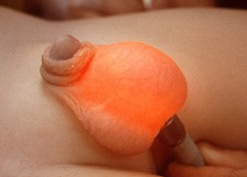 Transilüminasyon Testi - hidrosel