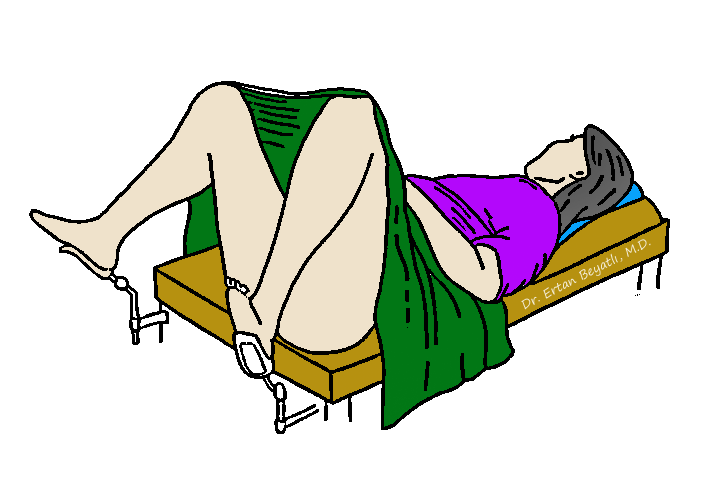 Hemoroid ameliyatı hangi pozisyonda yapılır? Jinekolojik (litotomi) pozisyonunda hasta sırtüstü yatırılır ve bacaklar askıya alınır.