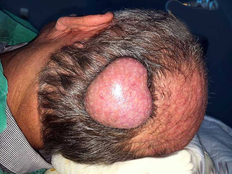 kafada sebase adenom