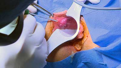 нехирургично лазерно лечение на хемороиди