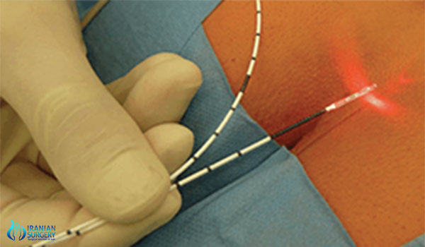 الليزر الحديث في علاج البواسير