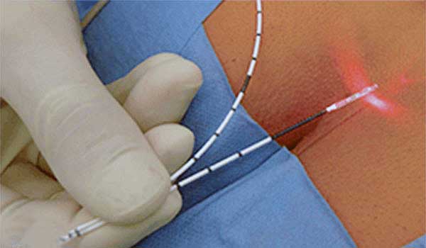 Lazerle Hemoroid tedavisi ameliyatsız 2021