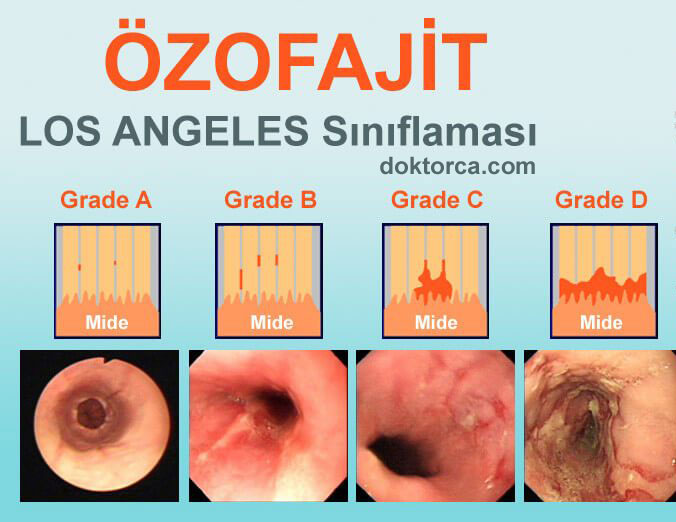 Özofajitin LA (Los Angeles) Sınıflanması