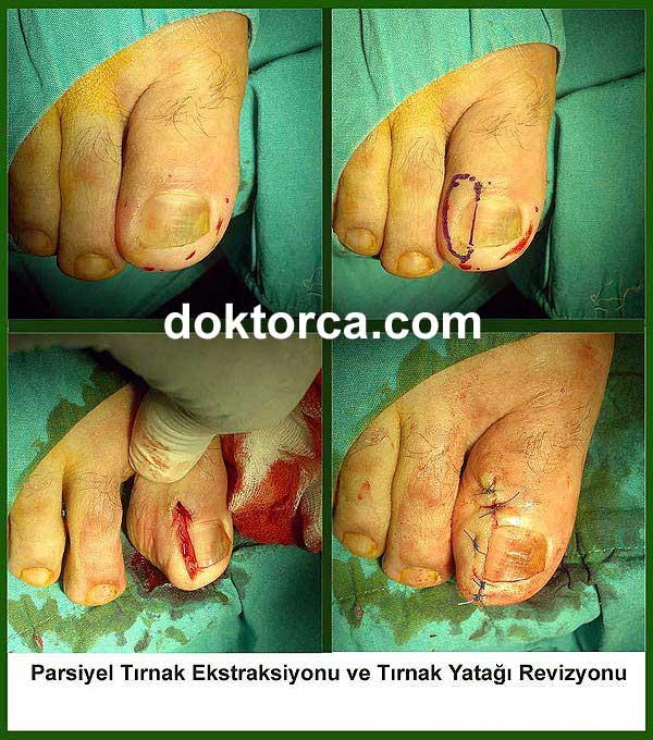 Tırnak Batması