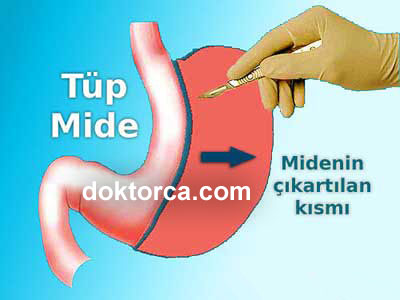 Tüp Mide ameliyatı