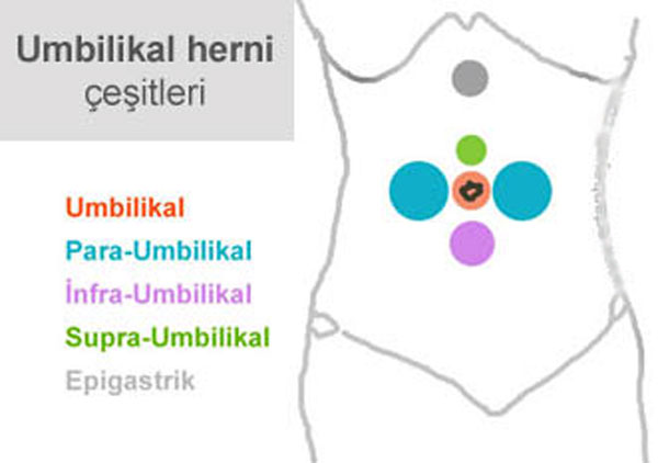 Göbek Fıtığı (Umblikal Herni)