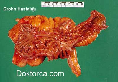 Patolojide görülen CROHN değişikliği