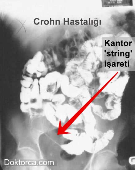 CROHN Hastalığı - İnce Barsak pasaj grafisinde görülen Kantor ve 'string' işareti