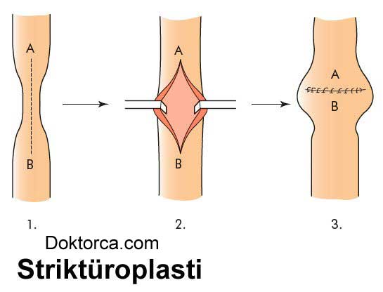 Striktüroplasti işlemi