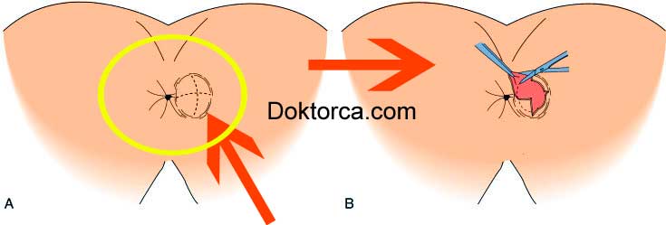 Anal Abse Boşaltması - Apse drenajı