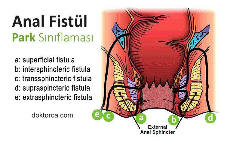 Anal Fistül - Park Sınıflaması