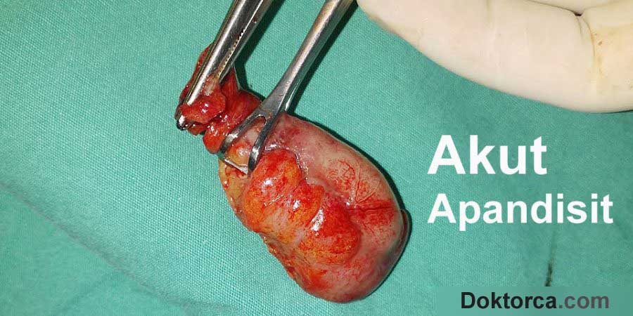 Apandisit nasıl anlaşılır?