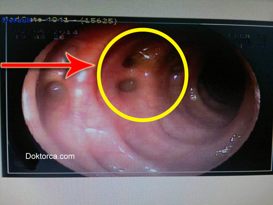 Divertikül Nasıl Anlaşılır?