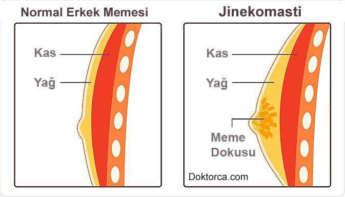 Erkeklerde Meme Büyümesi (Jinekomasti)