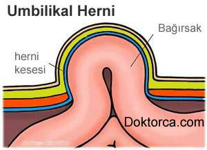Göbek fıtığının anatomisi - Turuncu çizgi fasiadır ve herni alanında devam etmediği dikkat çekmektedir.
