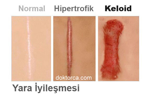keloid ve hipertrofik skar farkı