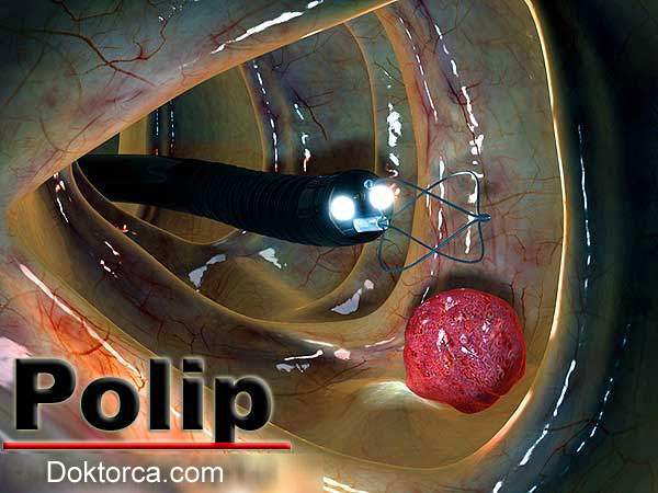Kolonda et beni (Polip) kanser mi?