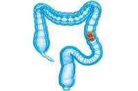 Kolon polipleri en sık sol tarafta rastlanır