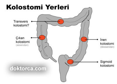 kolostomi nedir?