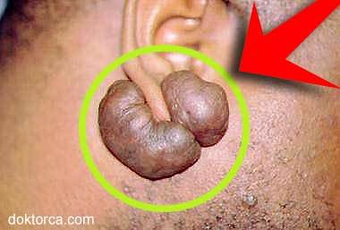 Kulak arkası Keloid