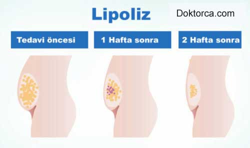 lipoliz nedir? nasıl yapılır?