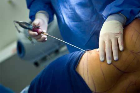 Liposuction nasıl yapılır?