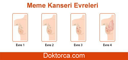 Meme Kanseri kaç evreden oluşur