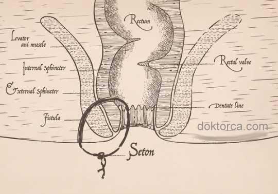 Anal Fistül - Park Sınıflaması