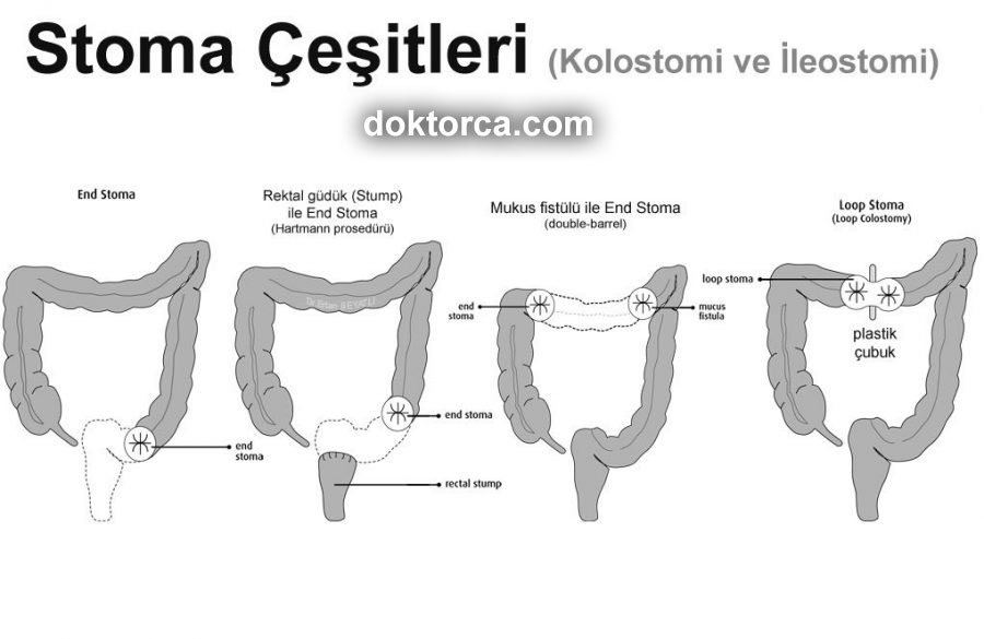 Stoma çeşitleri