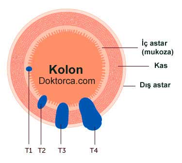 Kolorektal kanseri için T - staging