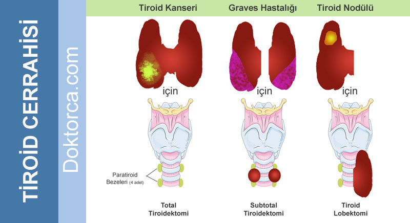 Tiroid Cerrahisi Çeşitleri