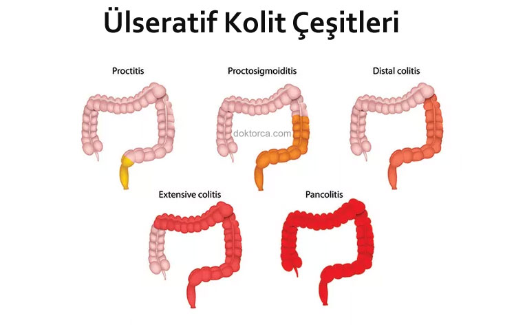 Ülseratif Kolit Çeşitleri