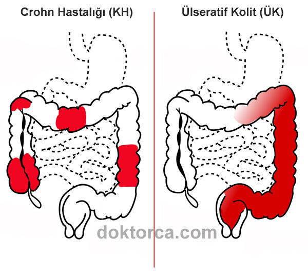  CROHN Hastalığı ve Ülseratif Kolit 